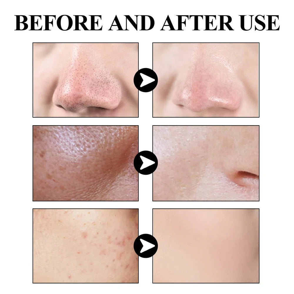 West & Month Mascarilla Facial de Barro Sólido para Eliminar Puntos Negros: Refresca, Limpia, Hidrata, Controla la Grasa y Reduce Poros (Poros Prohibidos)
